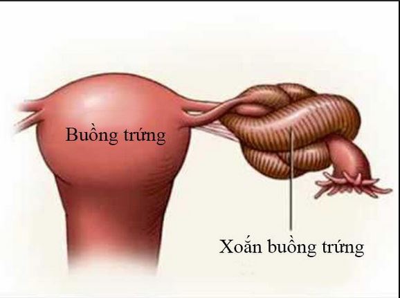 Những Dấu Hiệu Cần Chú Ý Về Xoắn U Nang Buồng Trứng Ở Phụ Nữ