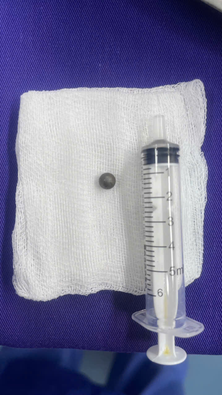 z7605129408597a3c2aa8827f0f159cc61f49d23134f30-1783941450989928610460 Bé trai 6 tuổi bị viên bi sắt xuyên vào xoang bướm khi chơi súng cao su - Ảnh 2.
