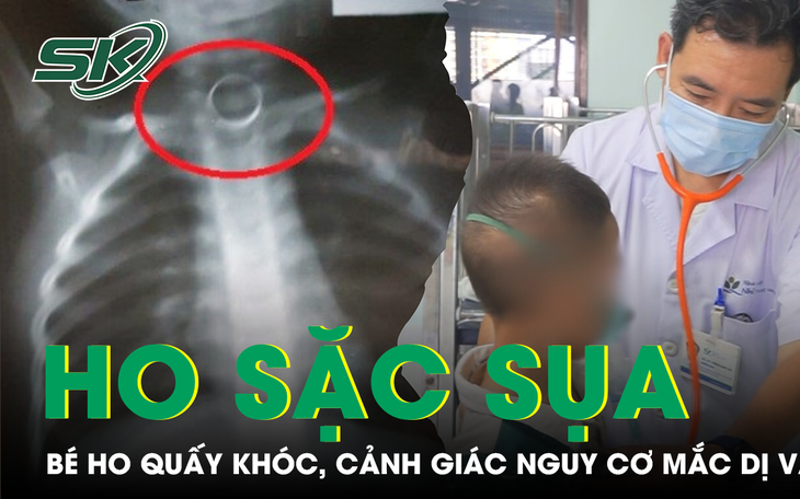 Cảnh Báo Về Nghi Ngờ Dị Vật Trong Khí Quản: Trường Hợp Đáng Lo Ngại Từ Xương Cá - Ảnh 3.