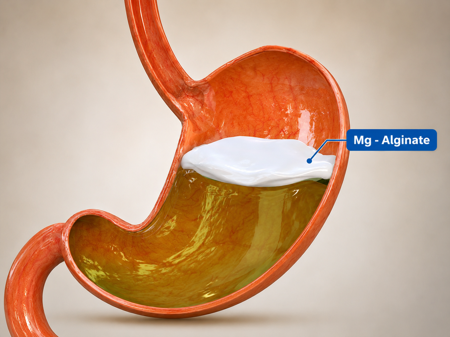 Giải pháp lớp gel 'bè nổi': Xu hướng trong kiểm soát trào ngược ở trẻ nhỏ- Ảnh 1.