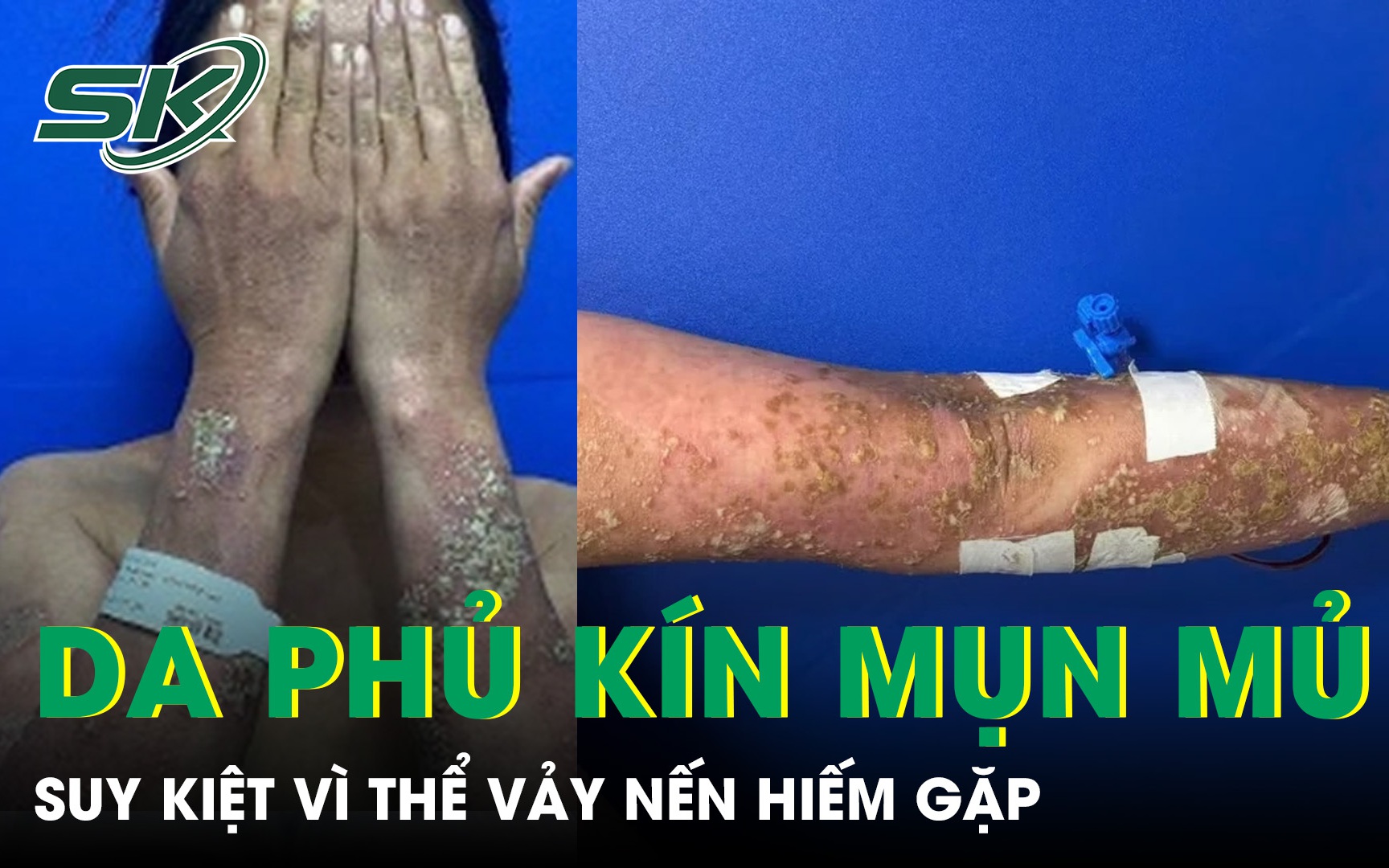 Nguy Cơ Tổn Thương Da Do Sử Dụng Thuốc Không Được Chuyên Gia Khuyên Dùng