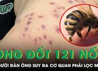 Khám Phá Tình Trạng Tiểu Khó: Những Nỗi Đau Âm Thầm Của Người Bệnh