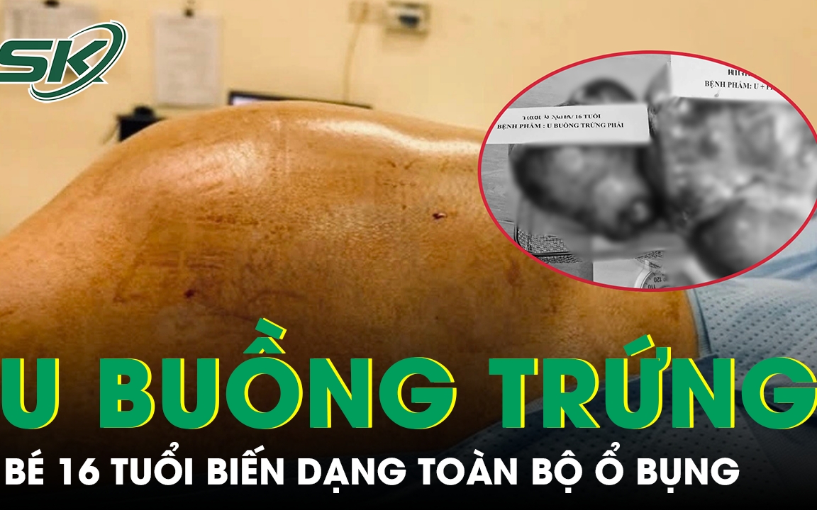 Cảnh Giác Với Khối U Buồng Trứng Ở Trẻ Em: Những Dấu Hiệu Quan Trọng Cần Biết