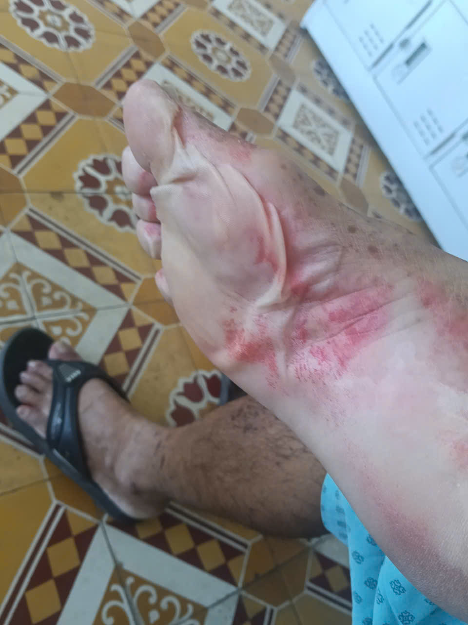 Cảnh Báo Dị Ứng Nghiêm Trọng Từ Thuốc Nhỏ Mắt: Câu Chuyện Cảnh Tỉnh Từ Bệnh Nhân