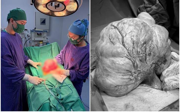 Lấy trọn khối u quái nặng 1,3 kg cho bé gái 5 ngày tuổi- Ảnh 2.