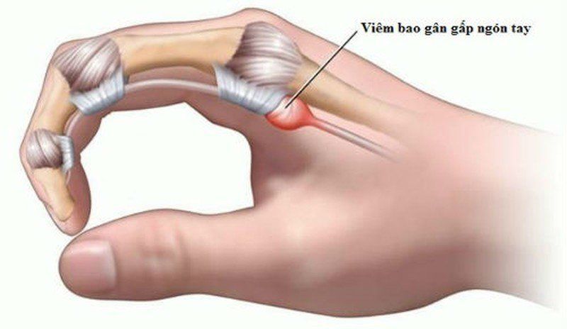 Hiểu Biết Về Viêm Gân Gấp Ngón Tay: Nguyên Nhân, Triệu Chứng Và Cách Phòng Ngừa