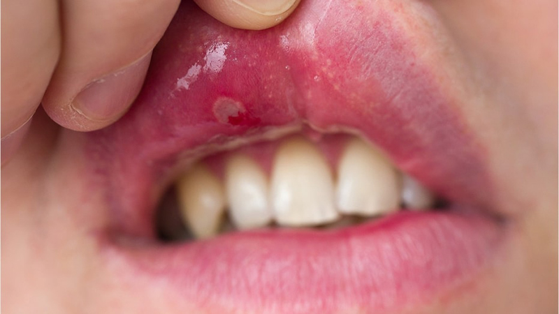 Người bệnh Lupus thường gặp vấn đề răng miệng. Ảnh B.S
