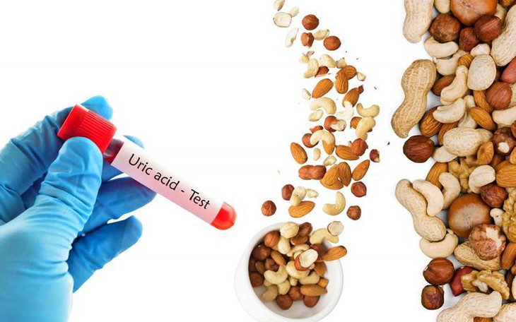Mối Liên Hệ Giữa Hoạt Động Thể Chất và Cơn Gout Sau Tuổi 50 - Ảnh 1.