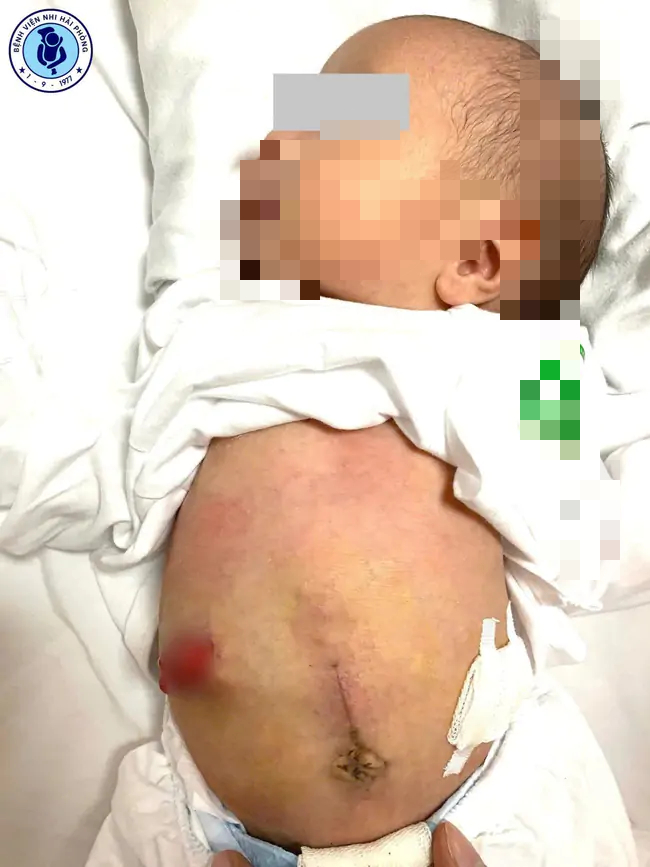 Câu Chuyện Cứu Sống Kỳ Diệu Tại Bệnh Viện Nhi Hải Phòng: Trẻ Sơ Sinh Thoát Chết Nhờ Phẫu Thuật Khẩn Cấp