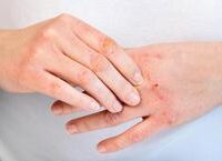 HIV: Tương Lai Sống Khỏe Với Điều Trị ARV