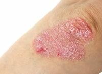 Tầm Quan Trọng của Xét Nghiệm ctDNA trong Vấn Đề Hóa Trị Sau Phẫu Thuật Ung Thư Đại Tràng