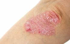 Những Điều Cần Biết Khi Nghi Ngờ Bị Viêm Da Tiếp Xúc