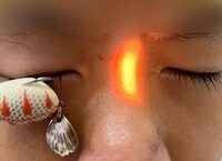 Mỡ Máu Cao: Nguy Cơ Tiềm Ẩn Gây Biến Cố Tim Mạch
