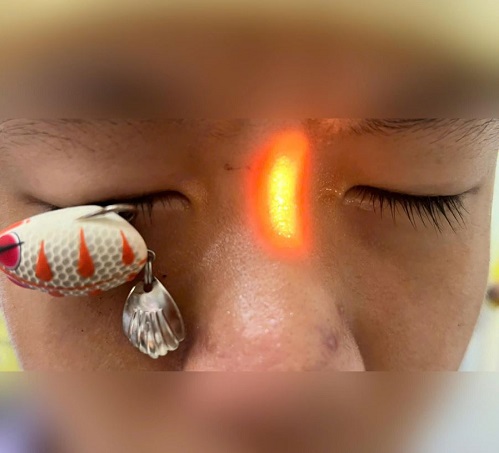 chan-thuong-mat-1787630623711665737957 Móc câu xuyên thủng mắt, bé trai 13 tuổi nguy cơ ảnh hưởng thị lực lâu dài - Ảnh 1.