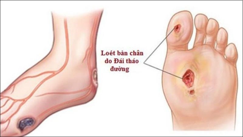 Những Biểu Hiện Cần Chú Ý Về Tê Rần Bàn Chân Ở Người Tiểu Đường