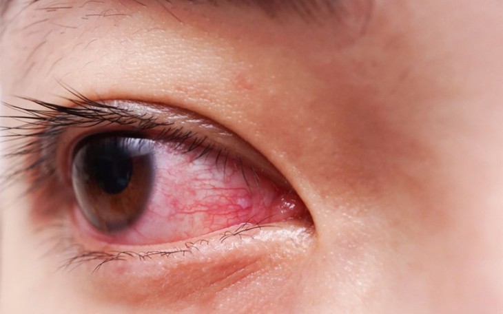 Những Sai Lầm Khiến Đau Mắt Đỏ Lây Lan Trong Gia Đình - Ảnh 4.