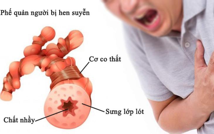Môn thể thao nào phù hợp nhất với người mắc bệnh hen phế quản? - Ảnh 1.