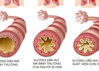Cảnh Giác: Dấu Hiệu Cần Nhận Biết Khi Trẻ Sặc Nước