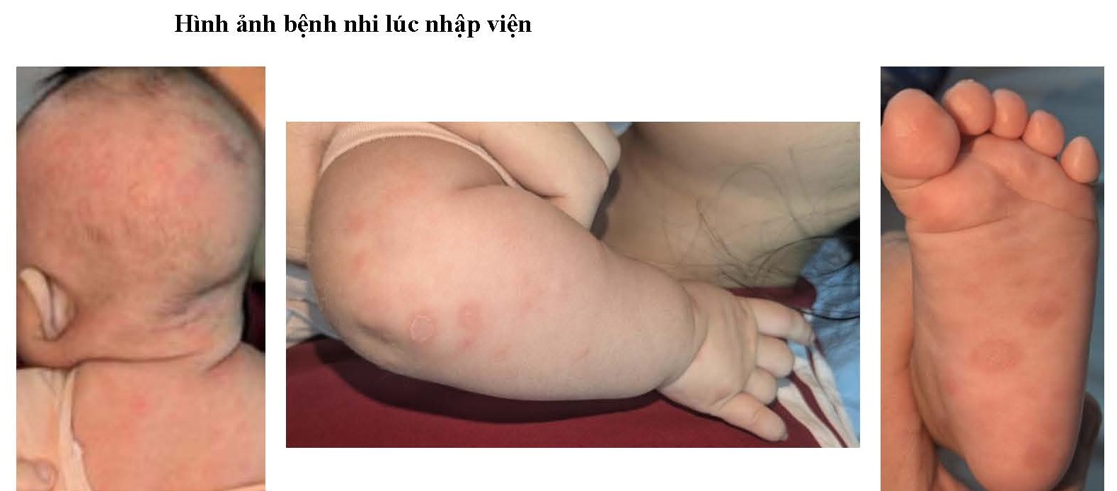 hinh-anh-tre-mac-giang-mai-bam-sinh-17869593503091243514914 Bé gái 2 tháng tuổi mắc giang mai, nhầm sang viêm da cơ địa- Ảnh 1.