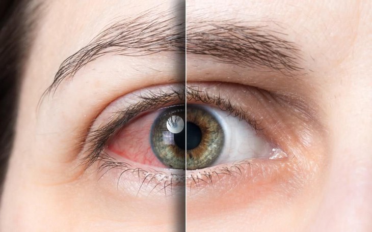 Khô mắt: Triệu chứng, Nguyên nhân và Cách xử lý hiệu quả