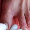 Tiêm Vaccine HPV: Khởi Đầu Bảo Vệ Sức Khỏe Trẻ Gái Từ Sớm