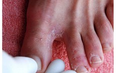 Tiêm Vaccine HPV: Khởi Đầu Bảo Vệ Sức Khỏe Trẻ Gái Từ Sớm