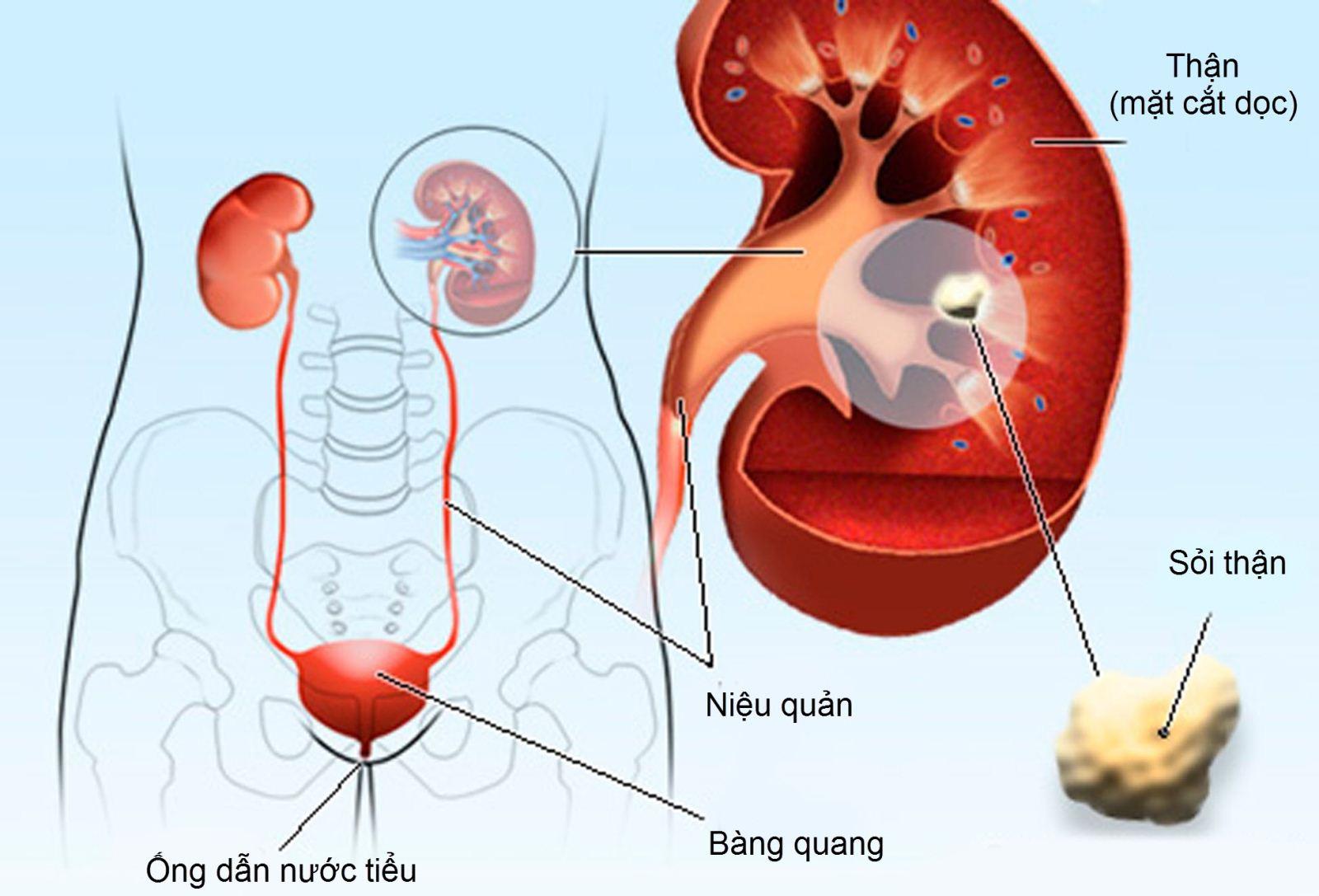 phong-tranh-soi-tiet-nieu-vao-mua-he1-1657251163617-1657251164210276267217 Sỏi tiết niệu ở trẻ: Phát hiện muộn có thể ảnh hưởng chức năng thận- Ảnh 2.