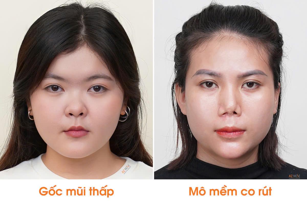 photo-1787561057261-1787561058020423517146 Nguyên tắc đánh giá chỉnh hình mũi ngắn- Ảnh 2.