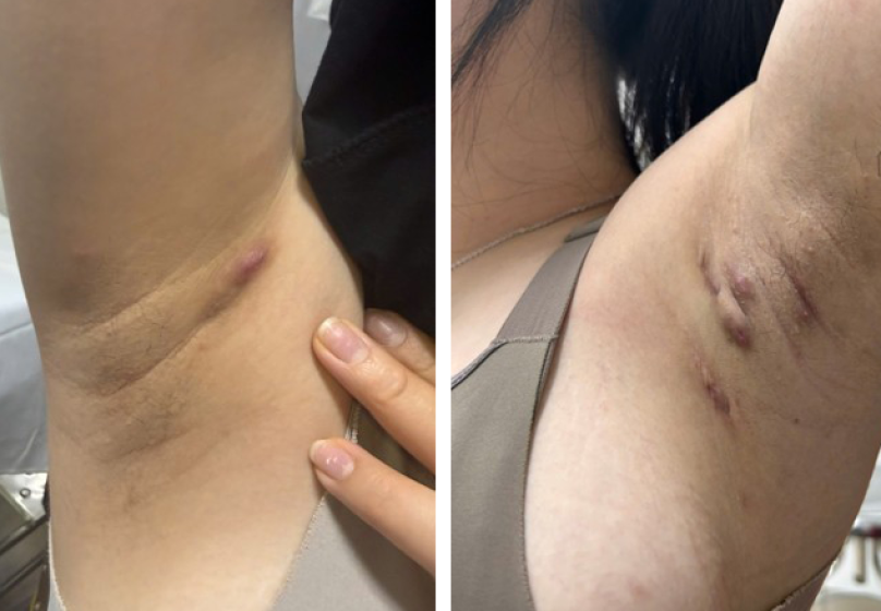 Viêm tuyến mồ hôi mủ thường bị nhầm với mụn trứng cá, viêm nang lông, nhọt, áp xe da hoặc lông mọc ngược. - Ảnh 1.
