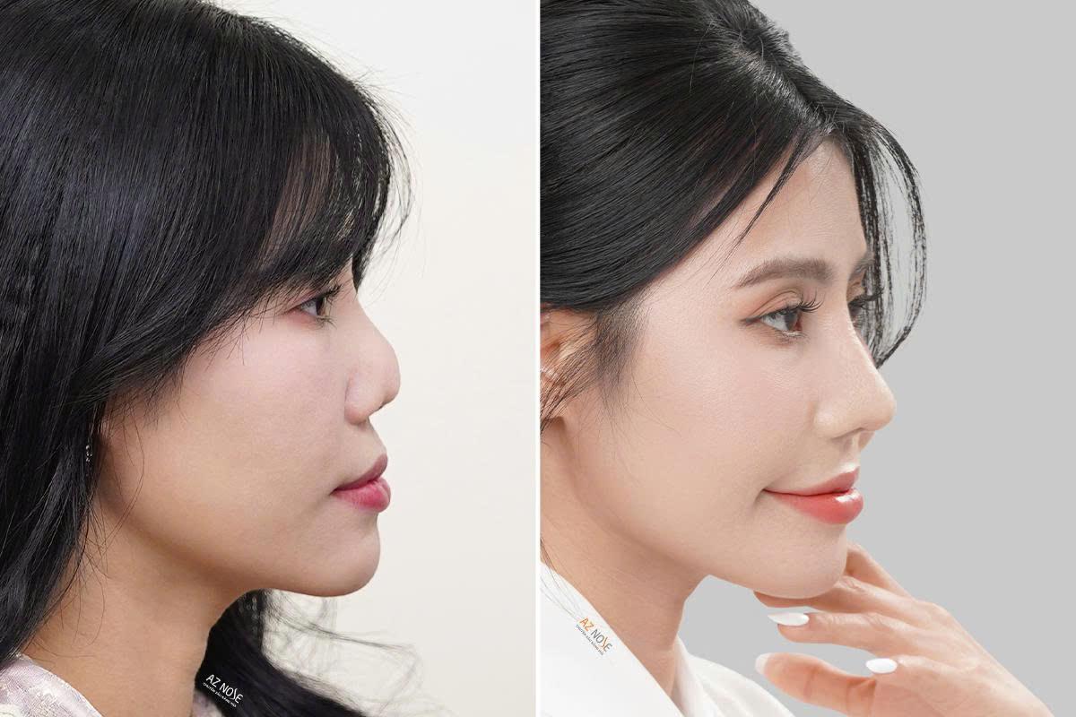 photo-1787887266659-1787887267344381302368 4 trường hợp cần nâng mũi cấu trúc - Ảnh 2.