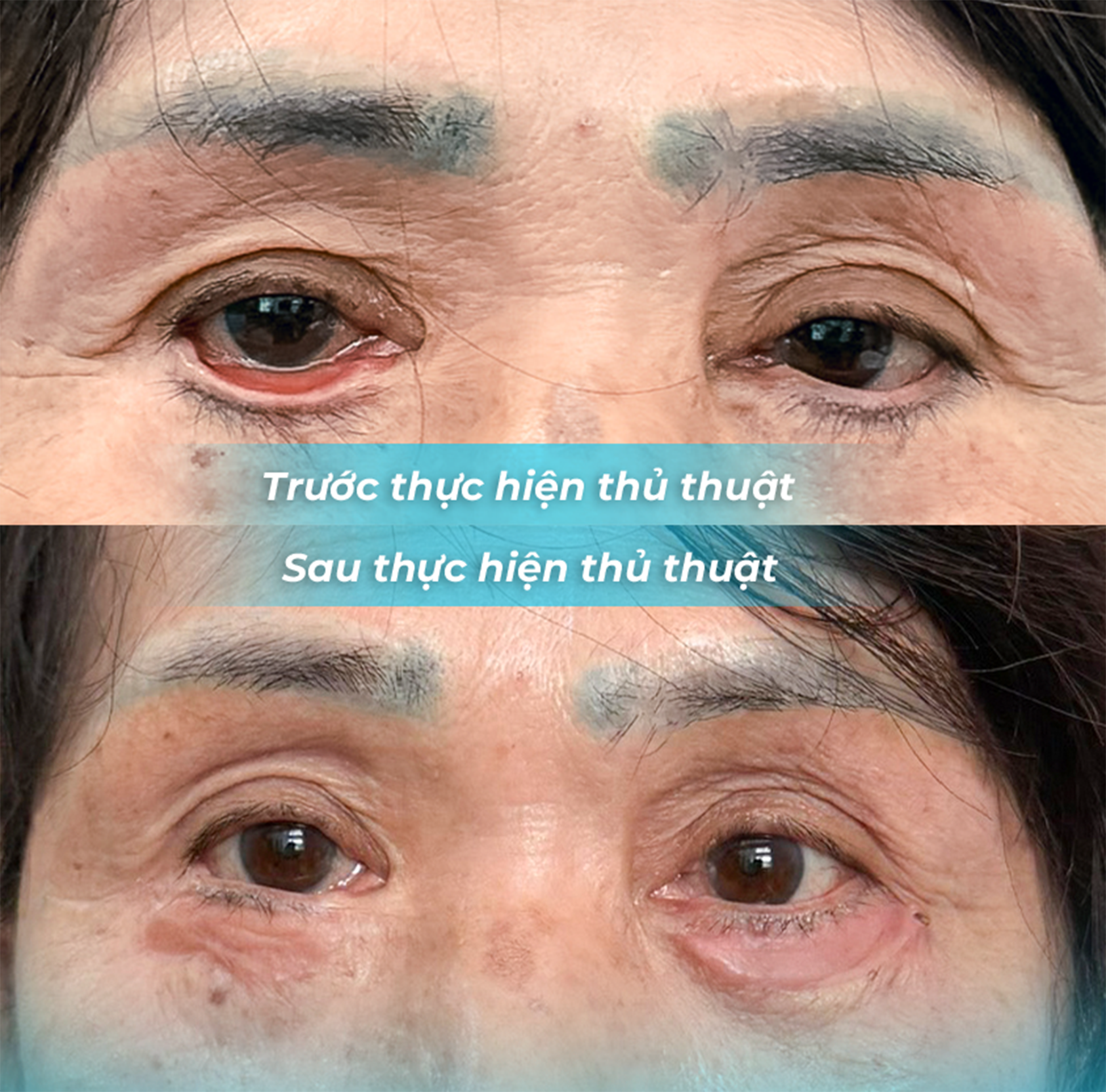 Câu Chuyện Biến Chứng Nặng Sau Phẫu Thuật Thẩm Mỹ: Lời Cảnh Tỉnh Cho Người Dùng