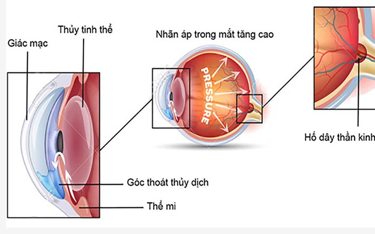 Ngăn ngừa tăng nhãn áp