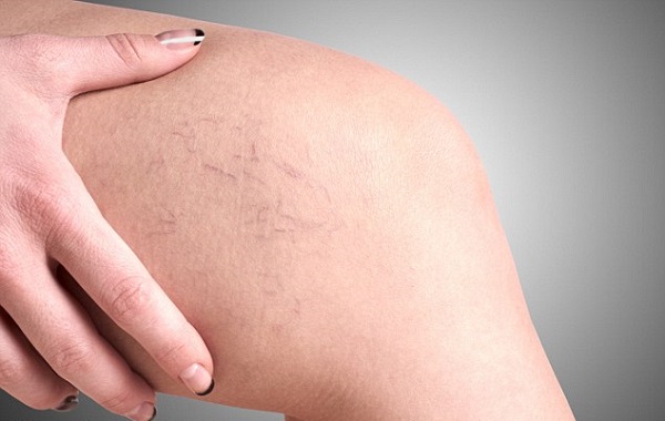 Những triệu chứng phổ biến của suy giãn tĩnh mạch chân Các triệu chứng của suy giãn tĩnh mạch chân.