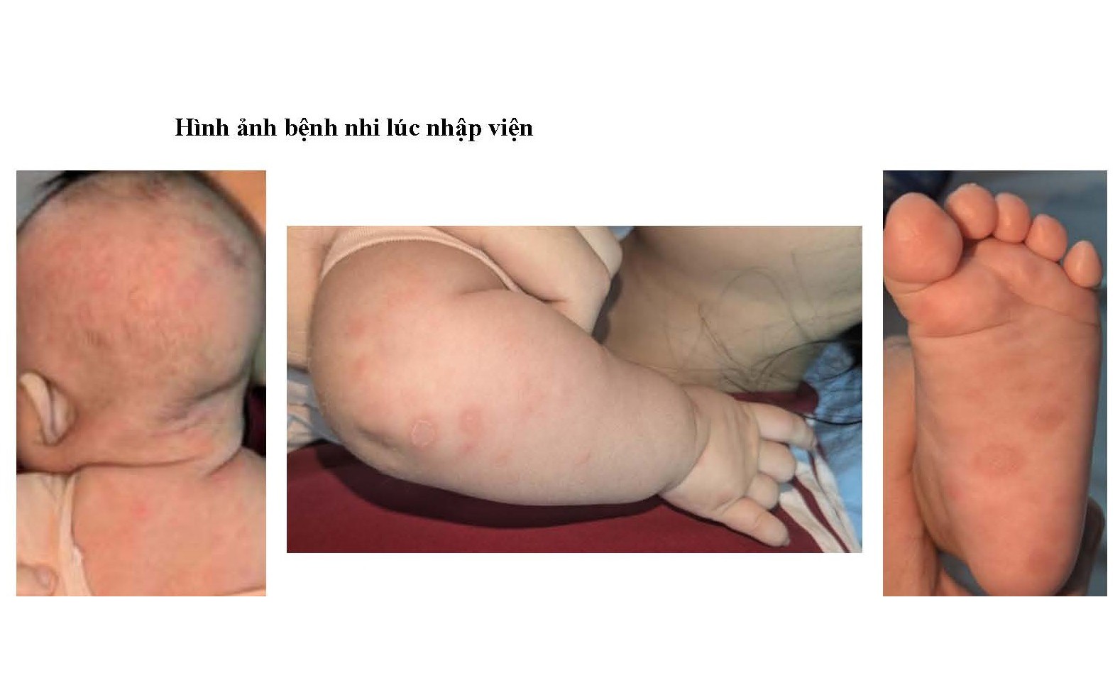 Phân biệt viêm da cơ địa với các bệnh da khác - Ảnh 2.