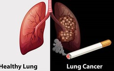 Cảnh Báo An Toàn: Trẻ Nhỏ Có Nguy Cơ Nuốt Dị Vật Nguy Hiểm