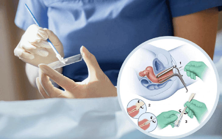 Những Hiểu Lầm Phổ Biến Về Ung Thư Cổ Tử Cung Bạn Cần Biết - Ảnh 3.