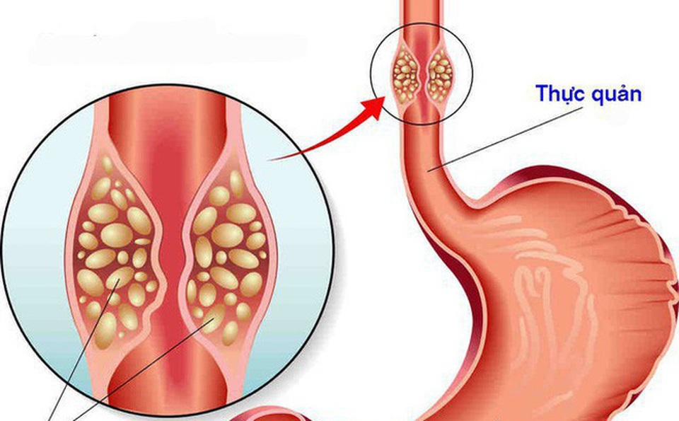 Hung thủ gây khó khăn trong việc nuốt