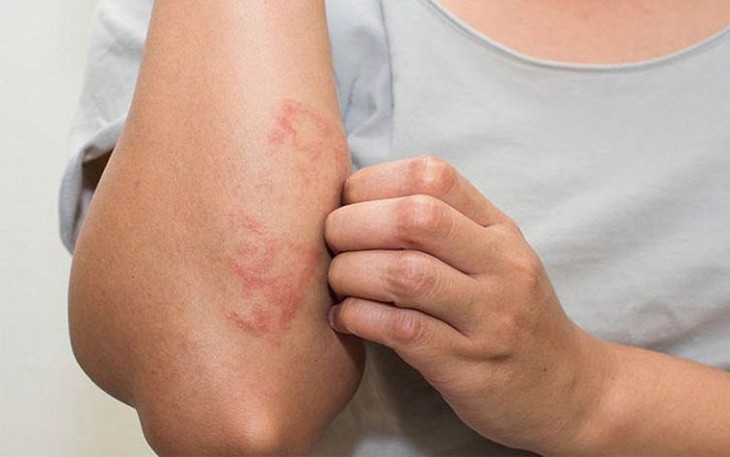 Cách Kiểm Soát Viêm Da Cơ Địa Hiệu Quả- Ảnh 1.