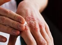 Hiểu Biết Về Block Nhĩ Thất Độ III: Nguyên Nhân, Triệu Chứng và Giải Pháp Can Thiệp Kịp Thời