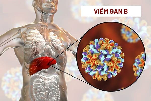 Viêm gan B cần kiêng gì để phòng biến chứng?- Ảnh 1.