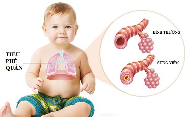 Những Triệu Chứng Và Cách Chăm Sóc Viêm Tiểu Phế Quản Cấp Ở Trẻ Nhỏ