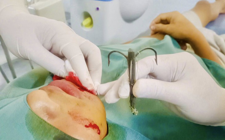 Lưỡi câu móc vào vành tai bé 10 tháng tuổi   - Ảnh 3.
