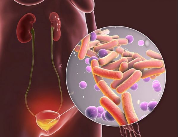 Lao tiết niệu dễ nhầm với bệnh gì, cách phát hiện? - Ảnh 1.