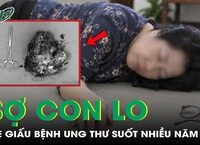 Cảnh Báo Sức Khỏe: Vết Đốt Dưới Ngực Có Thể Gây Nguy Hiểm Đến Tính Mạng