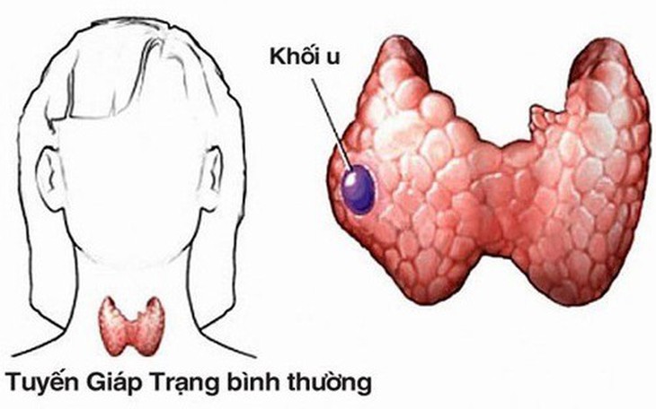 ung-thu-tuyen-giap-chua-duoc-khong-1673322265497869051488-21-0-334-500-crop-17466936284941433354132 Tiểu đường có làm tăng nguy cơ ung thư tuyến giáp?- Ảnh 1.